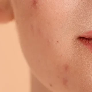 cbd for acne