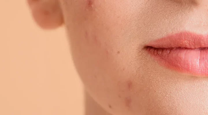 cbd for acne