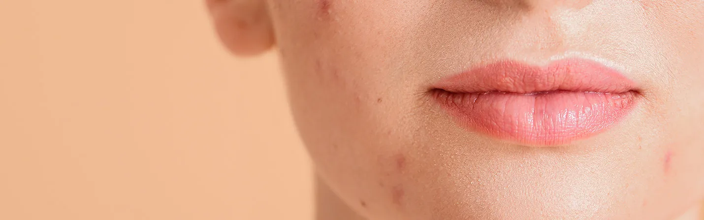 cbd for acne