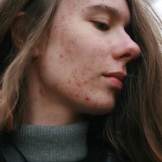 CBD for Acne uk scaled
