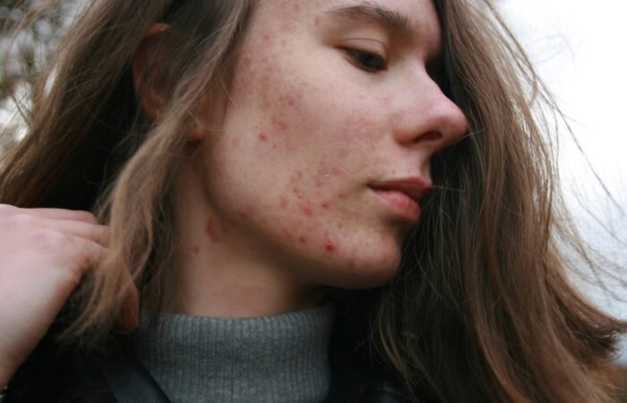 CBD for Acne uk scaled