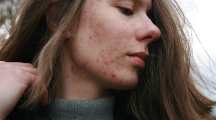 CBD for Acne uk scaled