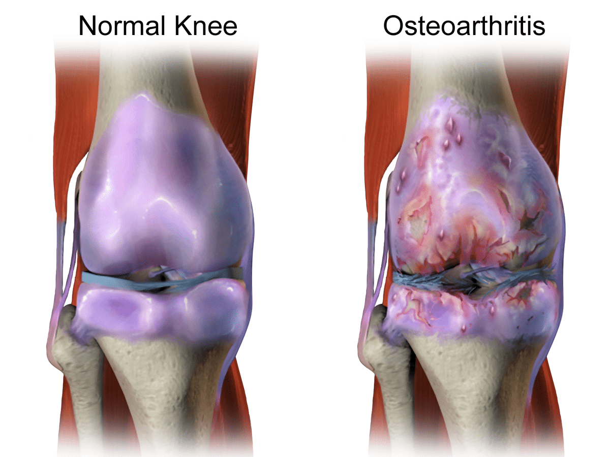 cbd oil for osteoarthritis 