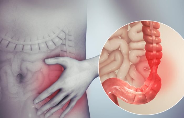 CBD for IBS
