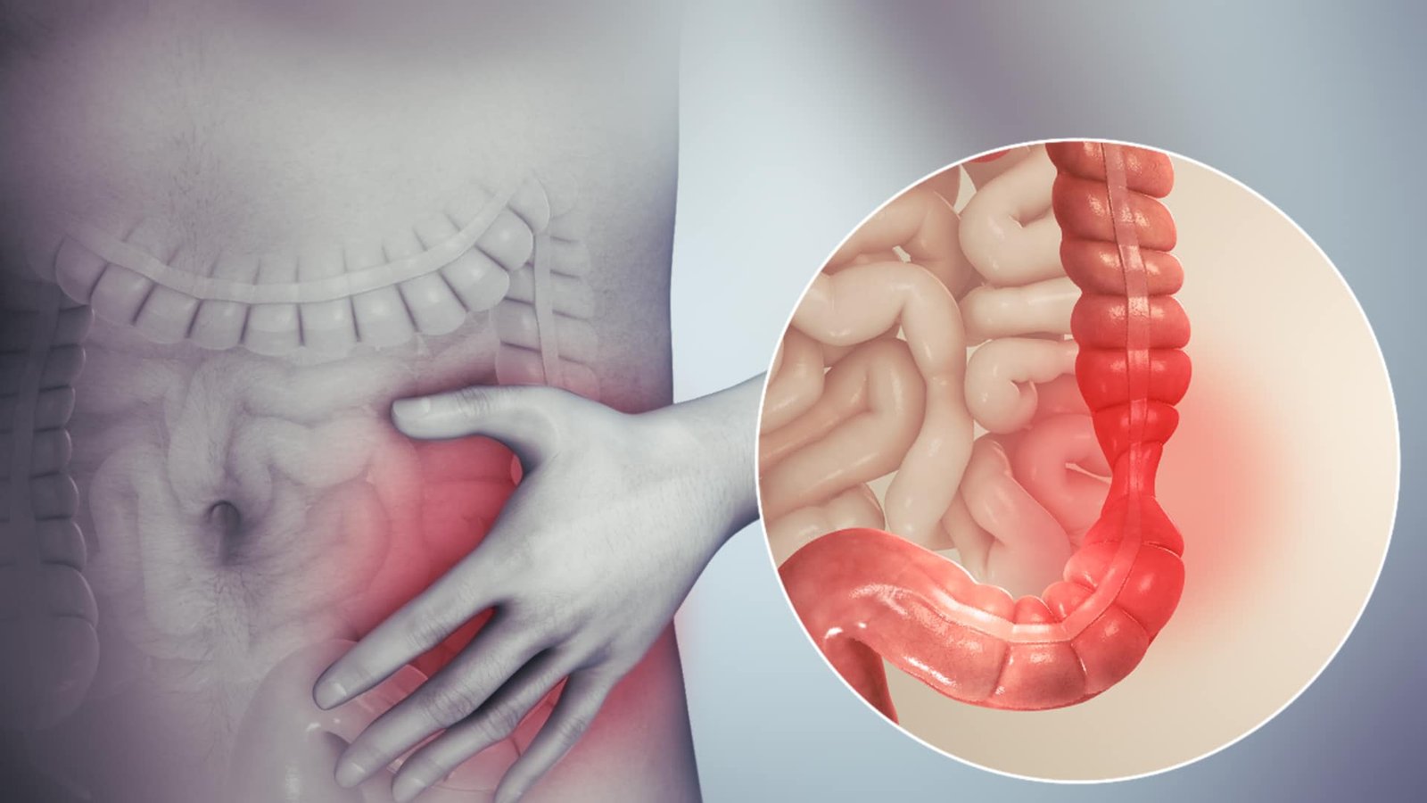 CBD for IBS