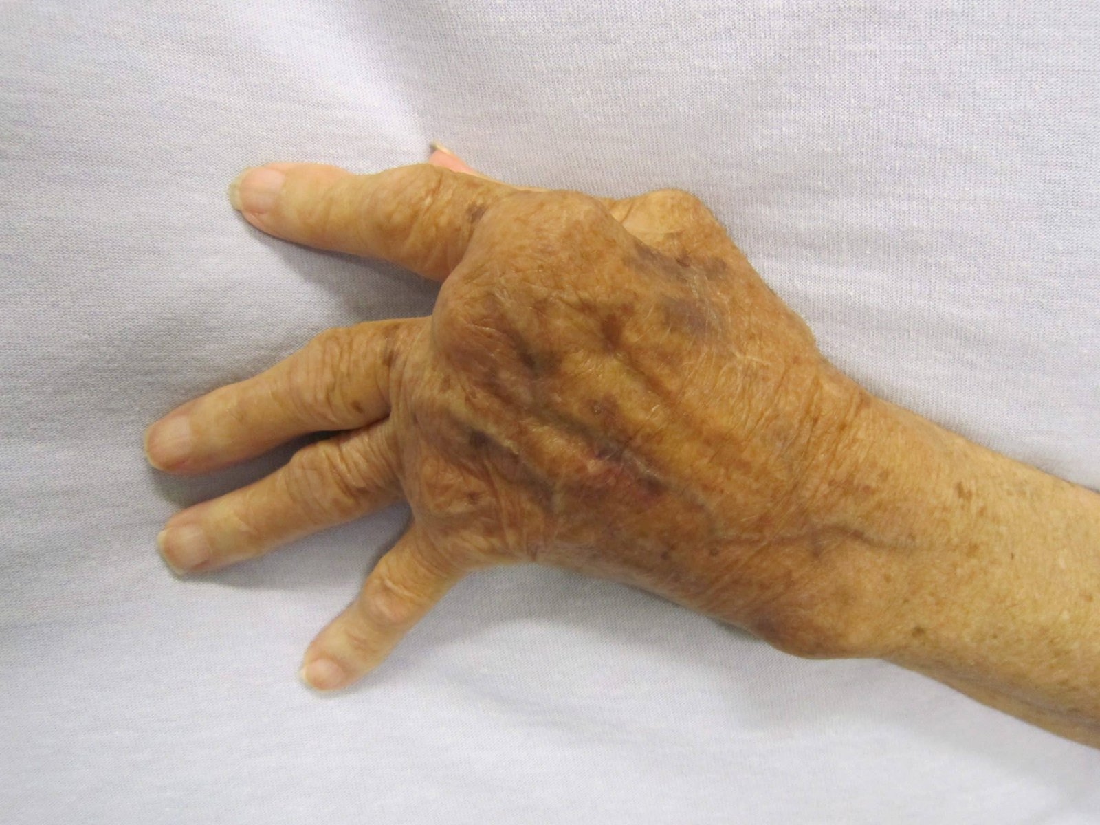arthritis scaled